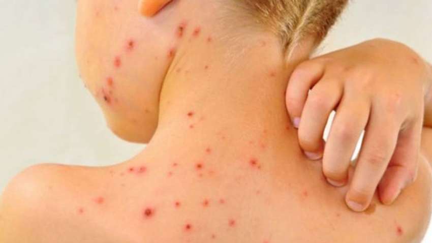 У Києві зафіксована рекордна кількість заражених на кір