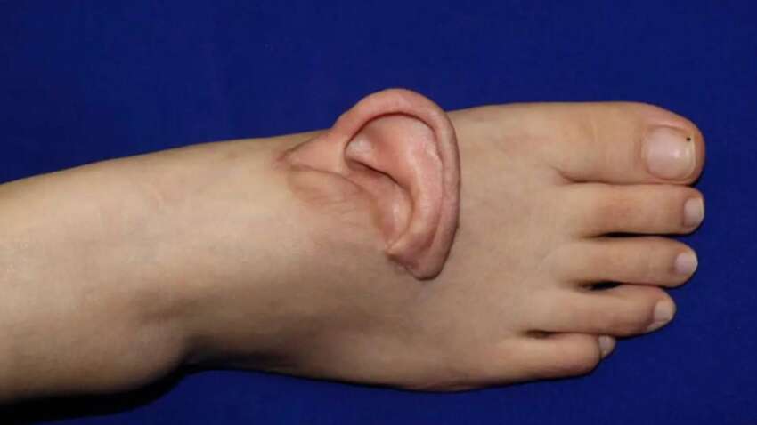 Пришили вухо до ноги: китайські хірурги пішли на шокуючий крок, щоб урятувати пацієнтку