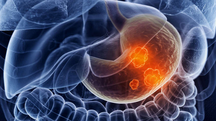 Онколог назвал простой способ избежать рака желудка Онколог назвал простой способ избежать рака желудка