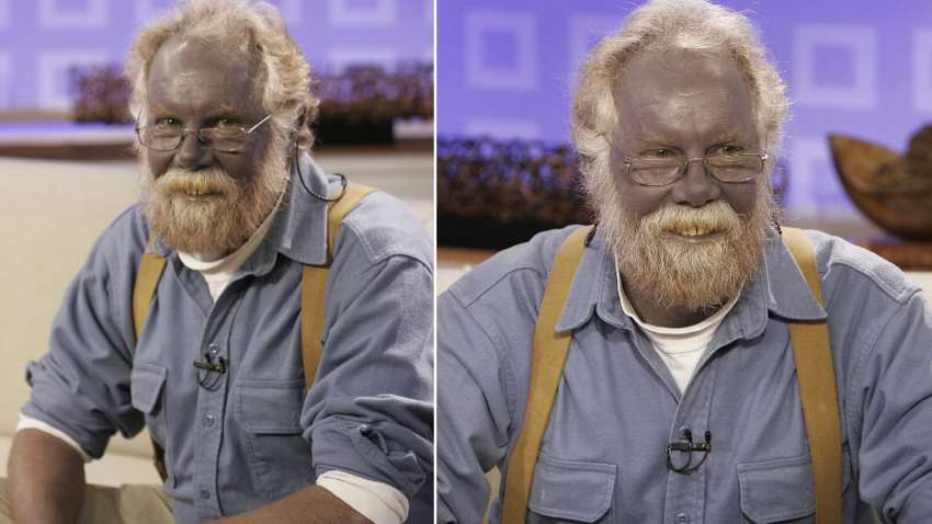 Небезпека альтернативної медицини: синя шкіра Пола Карасона - урок для всіх