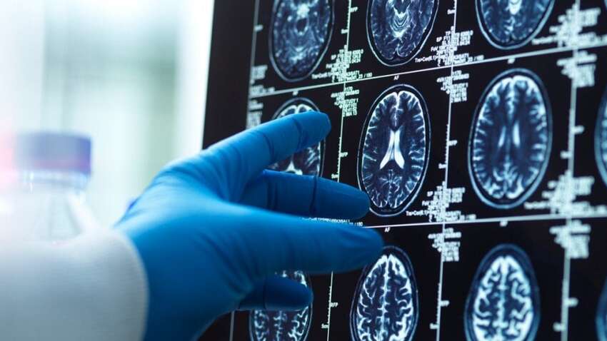 5 перших ознак деменції, які легко пропустити: термінове попередження від експертів  5 перших ознак деменції, які легко пропустити: термінове попередження від експертів