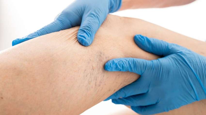 Загострення варикозу: як зберегти здоров'я ніг влітку