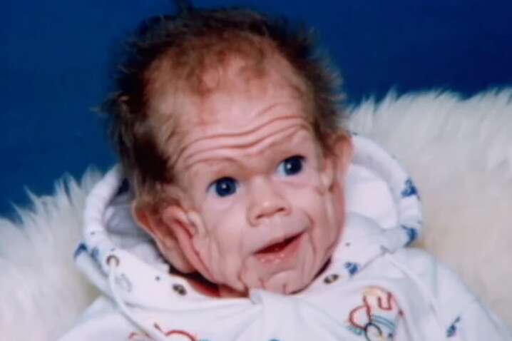 Хлопчик народився з обличчям старого: як він виглядає через 30 років