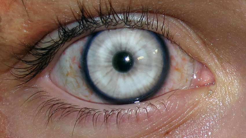 Впервые в мире: врачи восстановили роговицы с помощью технологий 
