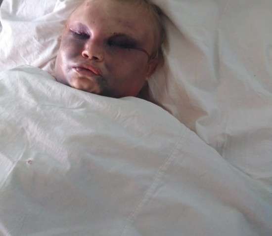 В РФ девушку использовали, как «боксерскую грушу»: ужасающие фото