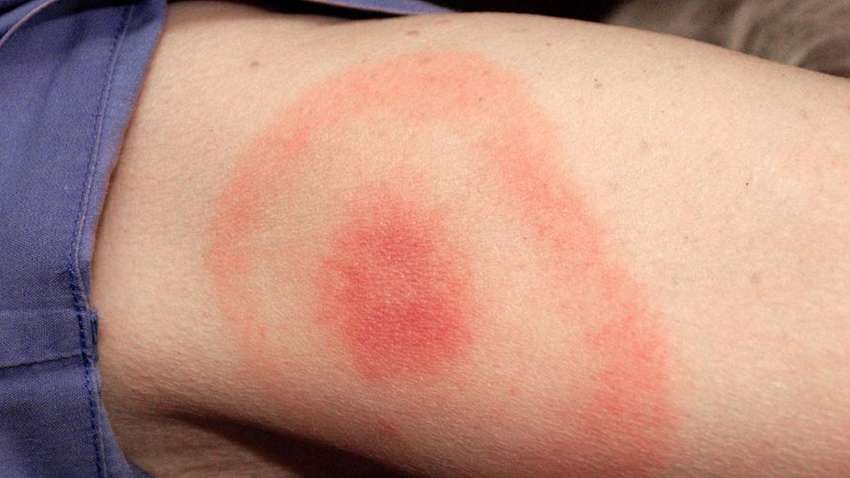 В Кировоградской области три женщины заболели тяжелой болезнью после укуса клещей