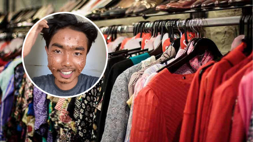 Парень заболел неприятной болезнью: во всем виновата одежда из секонд-хенда Парень заболел неприятной болезнью: во всем виновата одежда из секонд-хенда