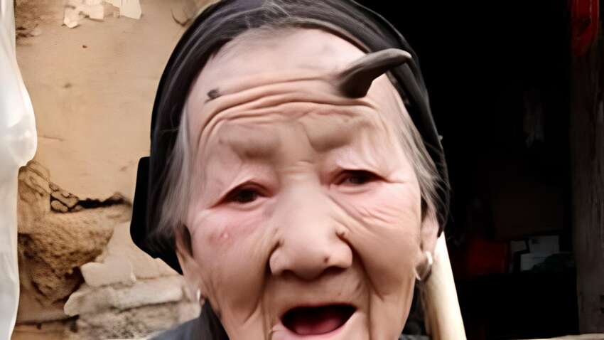 На лбу пожилой женщины вырос рог: медики поражены редким случаем в Китае На лбу пожилой женщины вырос рог: медики поражены редким случаем в Китае