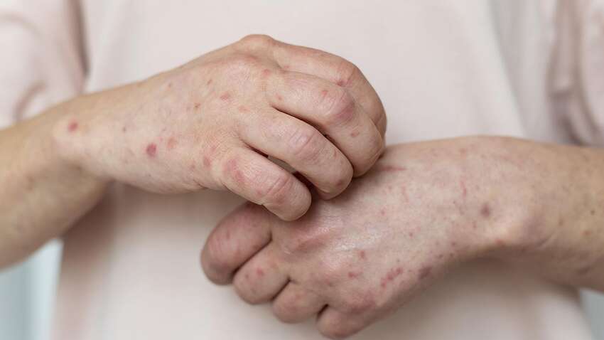 В Украине в 11 раз выросла заболеваемость опасной болезнью: о чем речь В Украине в 11 раз выросла заболеваемость опасной болезнью: о чем речь