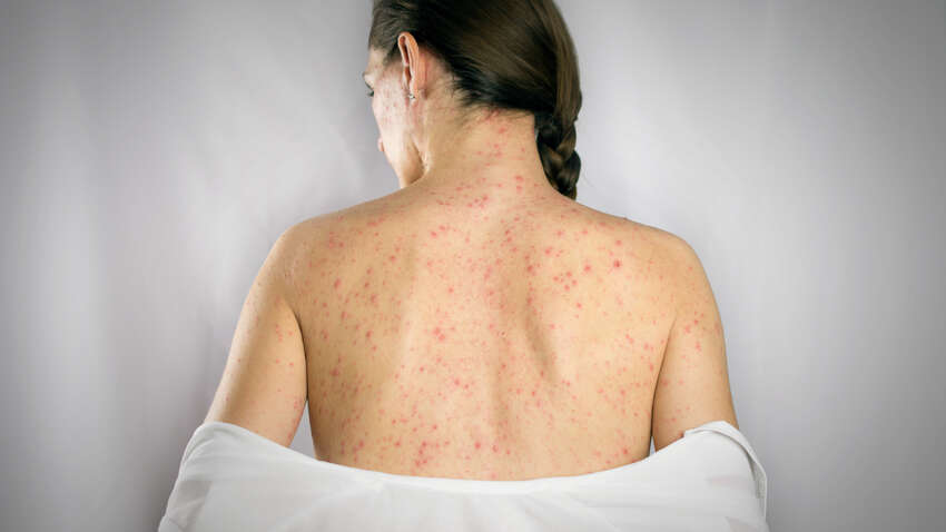 Кір повертається: в Україні за рік удесятеро зросла захворюваність Кір повертається: в Україні за рік удесятеро зросла захворюваність