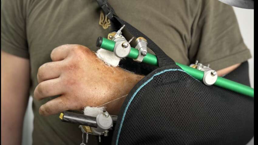 Рука трималася на клаптику шкіри: у Львові лікарі здійснили надскладну операцію після травми бензопилою