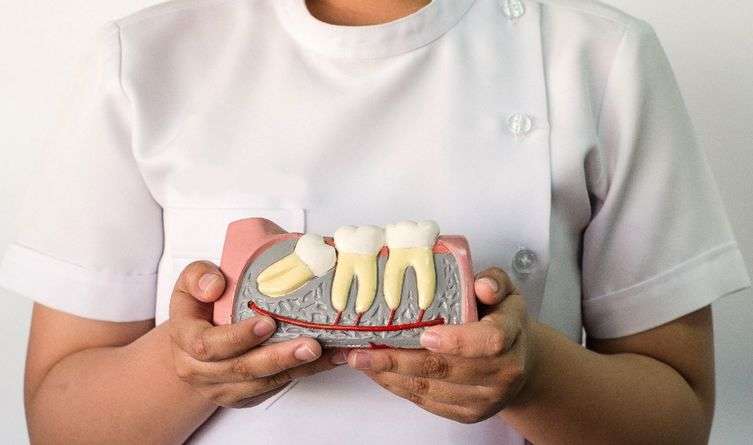 Стоматологи рассказали, нужно ли удалять зубы мудрости