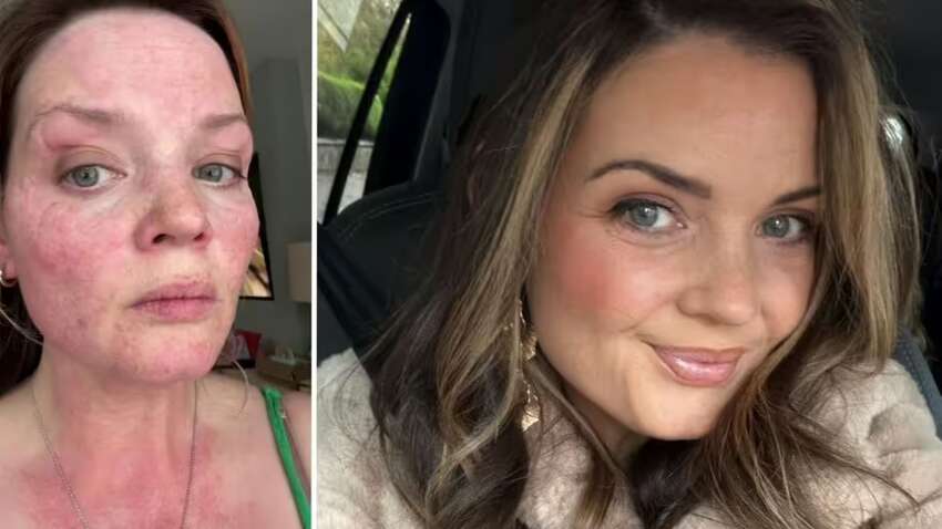 У женщины "аллергия на зиму": какие симптомы редкого заболевания (ФОТО)