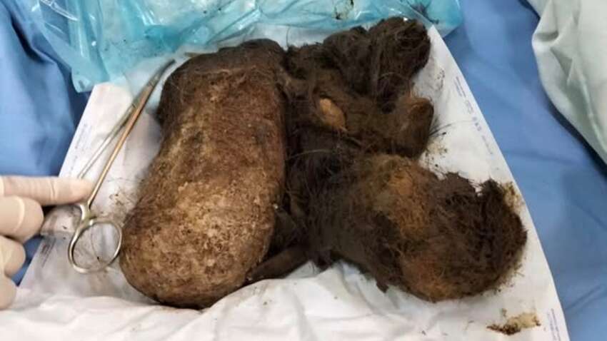 Почти килограмм волос в желудке ребенка: в Луцке врачи спасли 7-летнюю девочку от редкой патологии Почти килограмм волос в желудке ребенка: в Луцке врачи спасли 7-летнюю девочку от редкой патологии