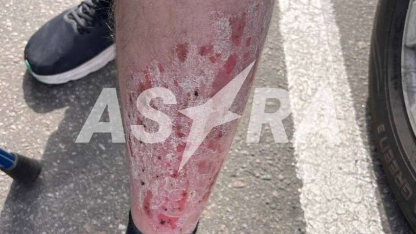 С какой болезнью солдат принудительно везут в «Шторм Z»: новые детали изнутри российской армии 