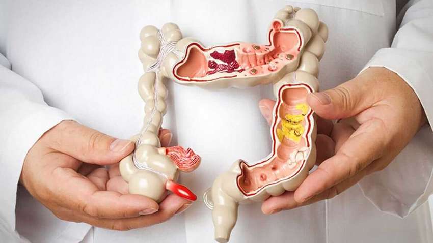 Які овочі допоможуть скоротити ризик розвитку раку кишечника