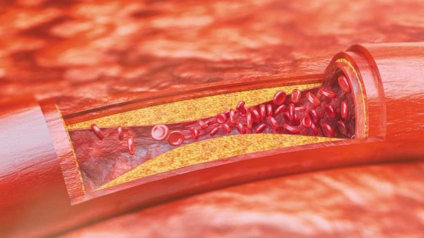 Дев'ять ознак того, що ви живете із забитими артеріями Дев'ять ознак того, що ви живете із забитими артеріями