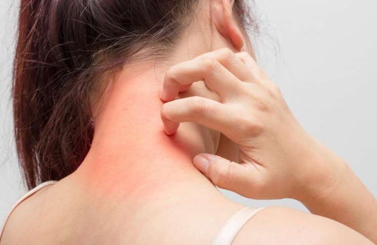 Вчені розповіли, як уберегти себе від атопічного дерматиту