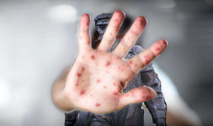 В Україні за тиждень на кір захворіли майже півтисячі людей