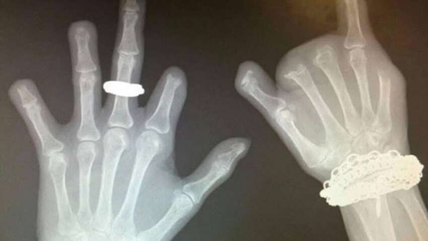 Звичка, яка може закінчитися ампутацією: медики показали шокуючий клінічний випадок