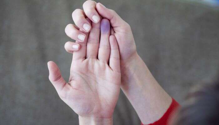 Если внезапно синеют пальцы – что это за симптом Если внезапно синеют пальцы – что это за симптом