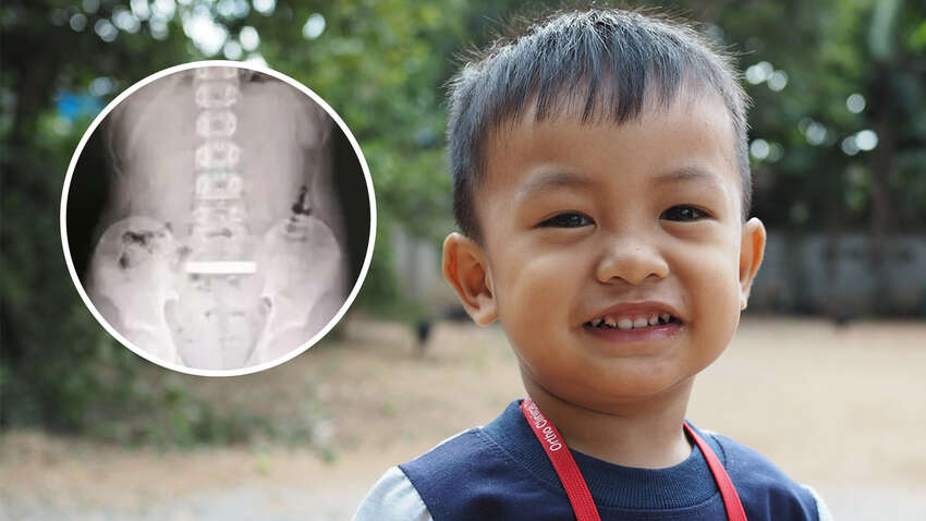 Врачи были удивлены, когда на рентгене увидели, что проглотил 11-летний мальчик Врачи были удивлены, когда на рентгене увидели, что проглотил 11-летний мальчик