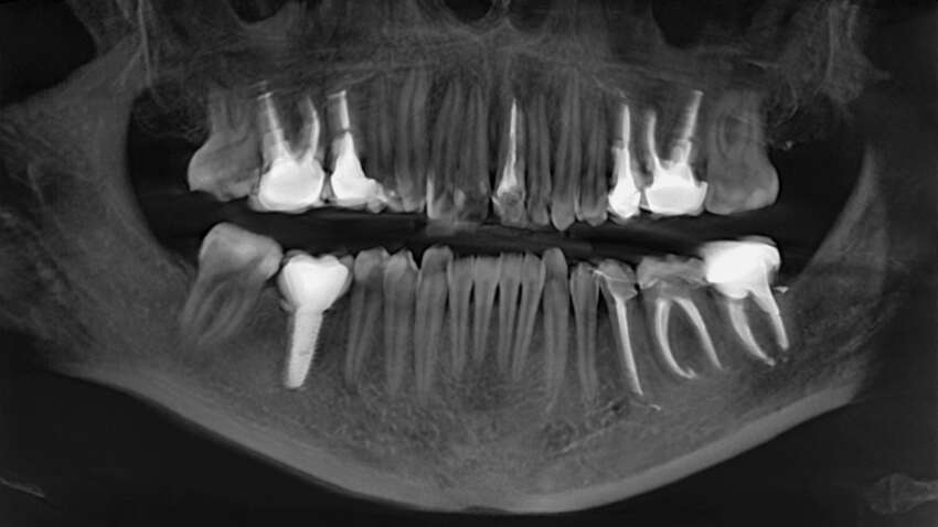 Инплантов не нужно – зубы будут расти сами