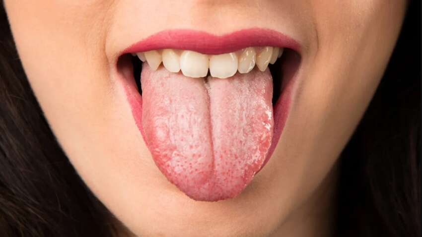 Білий наліт на язиці сигналізує про передраковий стан Білий наліт на язиці сигналізує про передраковий стан