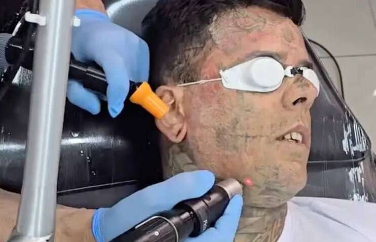 Найтатуйованіший бразилець звів усі татуювання з обличчя (ФОТО)