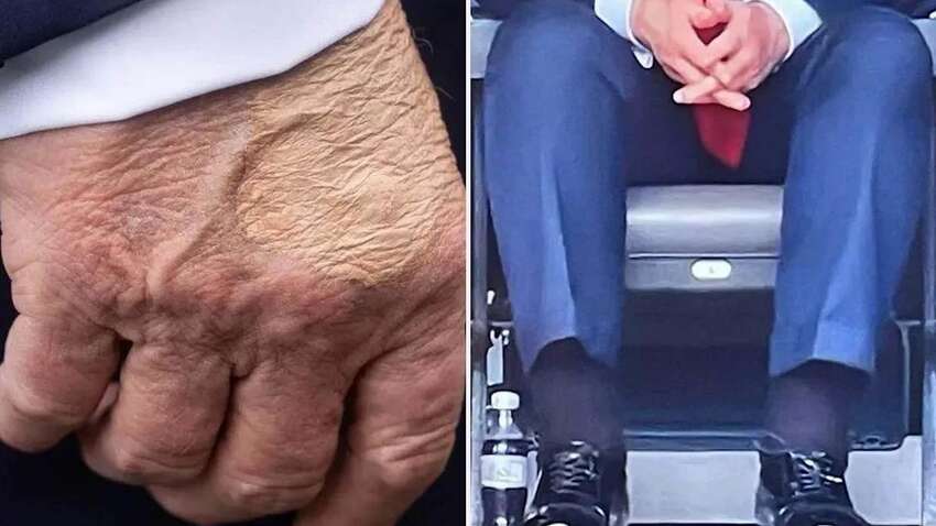 У Трампа начались серьезные проблемы со здоровьем: что об этом говорит У Трампа начались серьезные проблемы со здоровьем: что об этом говорит