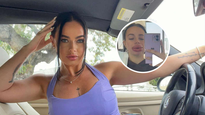 Жінка виграла безкоштовну процедуру збільшення губ: вона не очікувала такого ефекту Жінка виграла безкоштовну процедуру збільшення губ: вона не очікувала такого ефекту