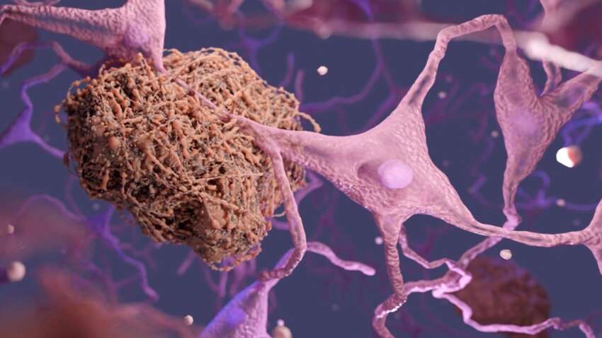 Ученые нашли способ остановить ключевой процесс болезни Альцгеймера