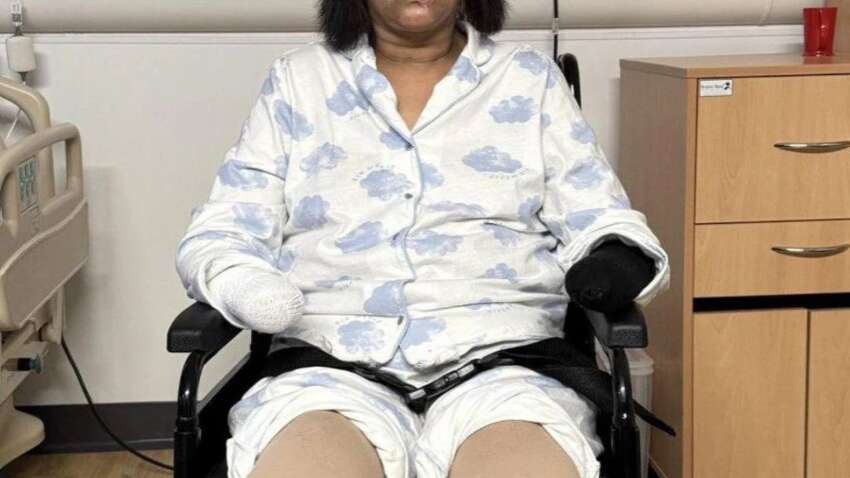 Рідкісна інфекція після лизання собаки призвела до ампутації чотирьох кінцівок Рідкісна інфекція після лизання собаки призвела до ампутації чотирьох кінцівок