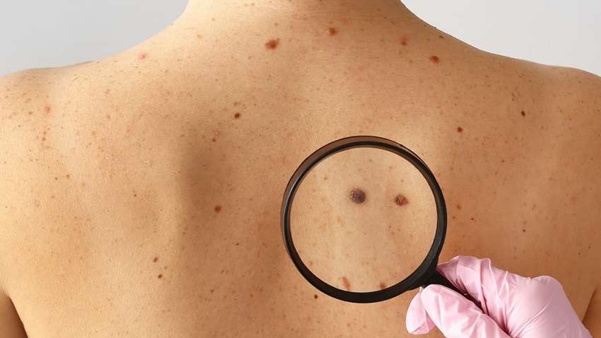 Рак кожи: что это такое и каковы его первые симптомы