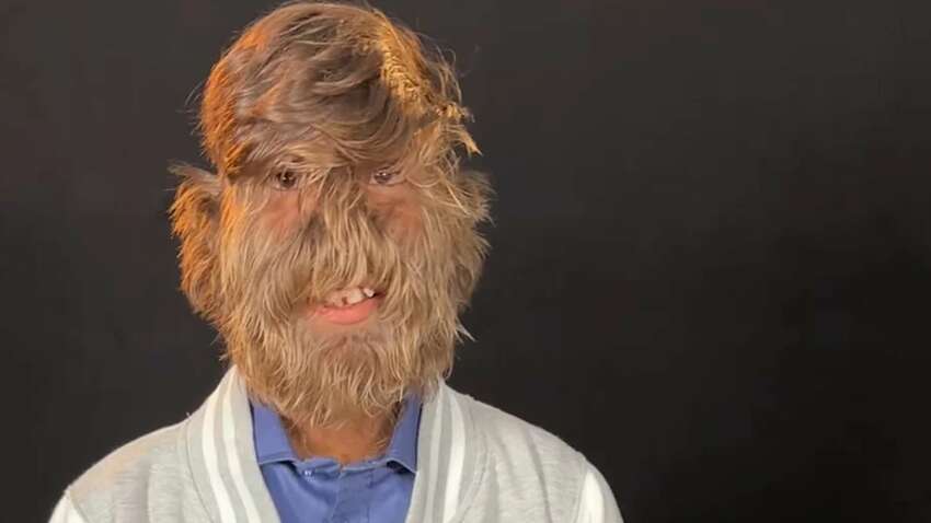 У 18-летнего парня самое волосатое лицо: он побил рекорд Гиннеса У 18-летнего парня самое волосатое лицо: он побил рекорд Гиннеса