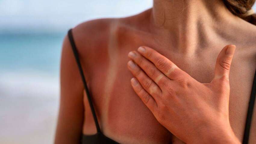 Худшая ошибка, которую вы можете совершить, когда "сгорите" на солнце Худшая ошибка, которую вы можете совершить, когда "сгорите" на солнце