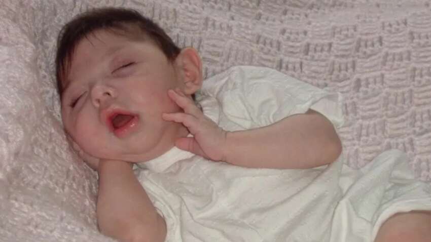 Женщина без мозга отпраздновала 20 лет: что известно о ее редкой болезни