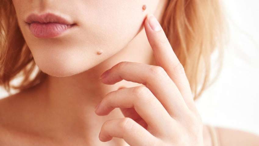 Британські вчені пояснили з чим пов'язана поява родимок