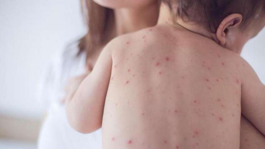 Загроза кору, краснухи та паротиту: в МОЗ б’ють на сполох через відсутність щеплень в українців