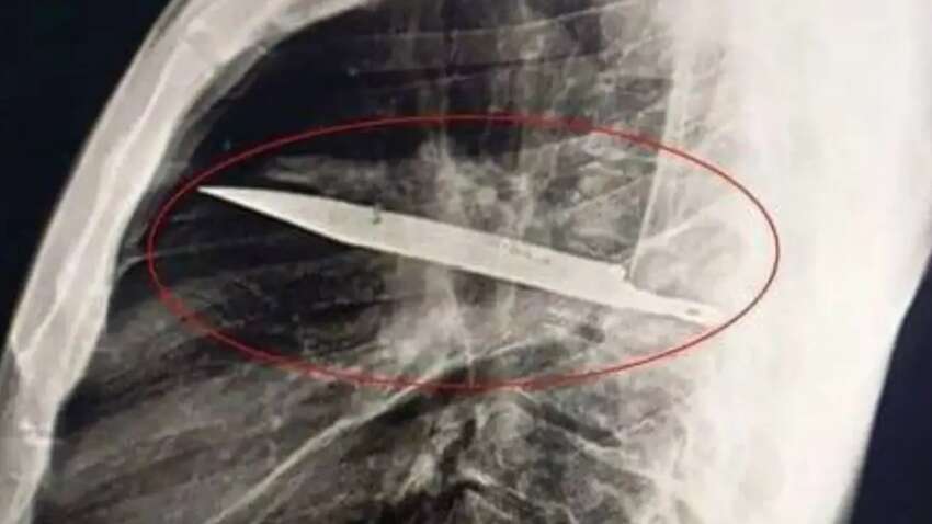 Мужчина 8 лет жил с ножом в груди и не знал об этом (ФОТО) Мужчина 8 лет жил с ножом в груди и не знал об этом (ФОТО)