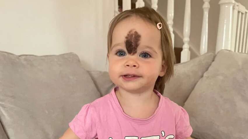 Дівчинка народилася з великою родимкою на лобі: як вона виглядає сьогодні Дівчинка народилася з великою родимкою на лобі: як вона виглядає сьогодні