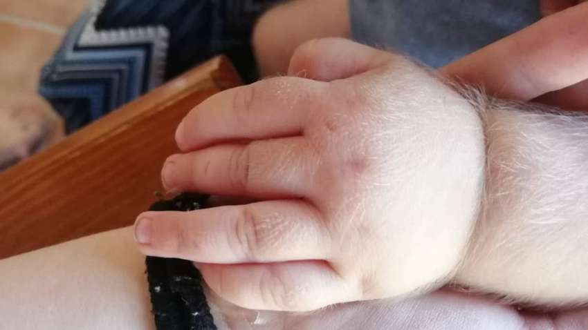 В Испании участились случаи рождения «детей-оборотней»: во всем обвинили медиков 