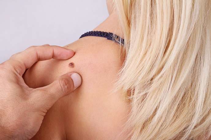 Родинки на теле: что приводит к их частому возникновению