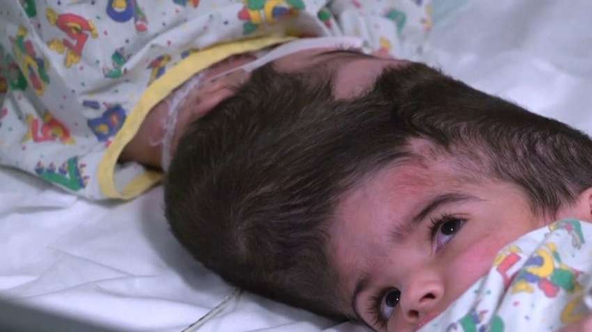 В Британии провели успешное разделение сиамских близнецов