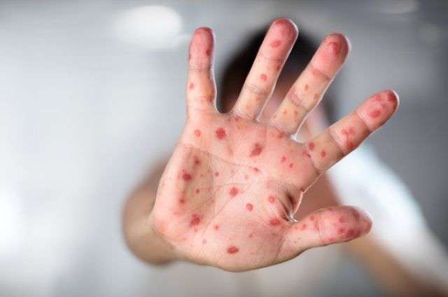 Кір в Україні: з'явилися нові дані про кількість хворих