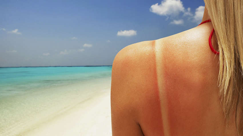 Что не нужно делать, если вы обгорели на солнце