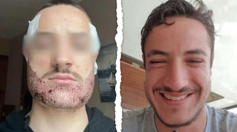 Хлопець вчинив самогубство після невдалої пересадки волосся на бороду
