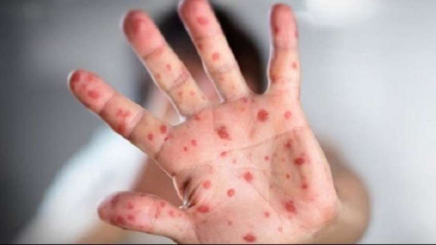 В Украине корью заболели более 55 тыс. человек – Минздрав 