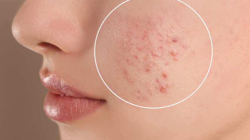 Эта скрытая болезнь проявляется прыщами и ухудшением состояния кожи Эта скрытая болезнь проявляется прыщами и ухудшением состояния кожи