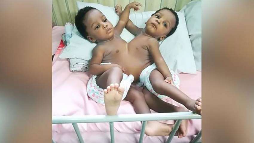 В Нигерии успешно разделили сиамских близнецов